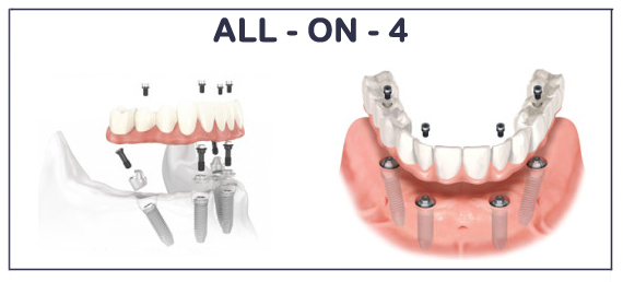 Метод имплантации зубов 